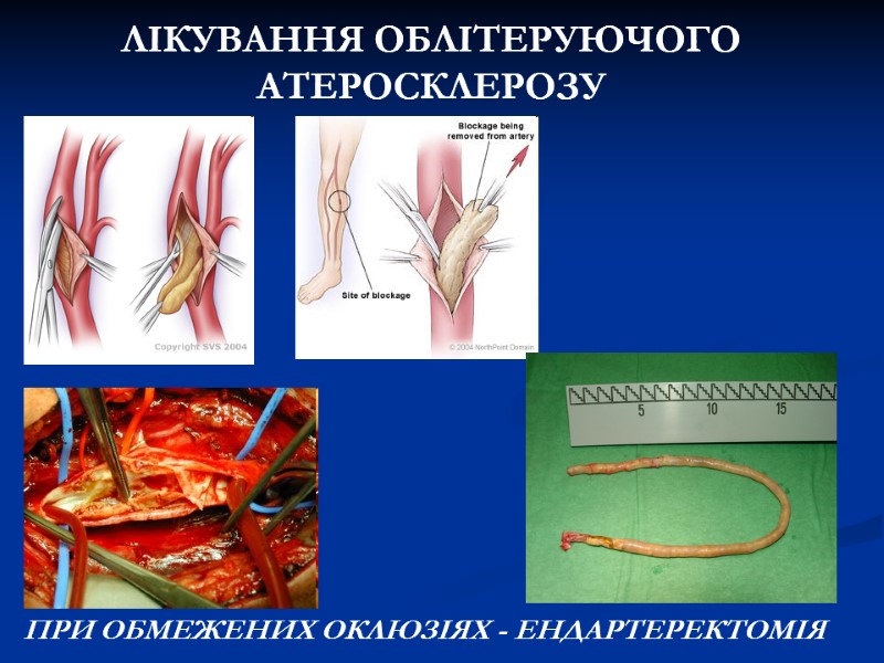 ЛІКУВАННЯ ОБЛІТЕРУЮЧОГО АТЕРОСКЛЕРОЗУ ПРИ ОБМЕЖЕНИХ ОКЛЮЗІЯХ - ЕНДАРТЕРЕКТОМІЯ ЛІКУВАННЯ ОБЛІТЕРУЮЧОГО АТЕРОСКЛЕРОЗУ ПРИ ОБМЕЖЕНИХ ОКЛЮЗІЯХ - ЕНДАРТЕРЕКТОМІЯ